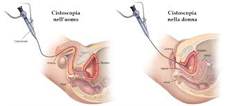 cistoscopia