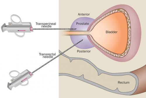 Nell'immagine l'immagine delle due tecniche nella parte superiore la versione con approccio perineale, in quello inferiore quello rettale