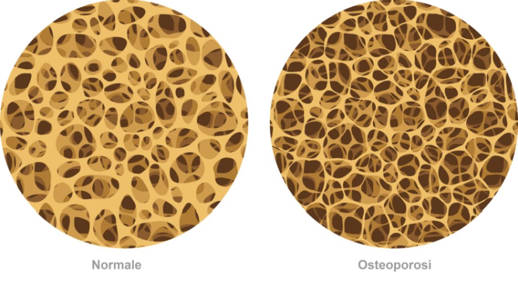 Osteoporosi