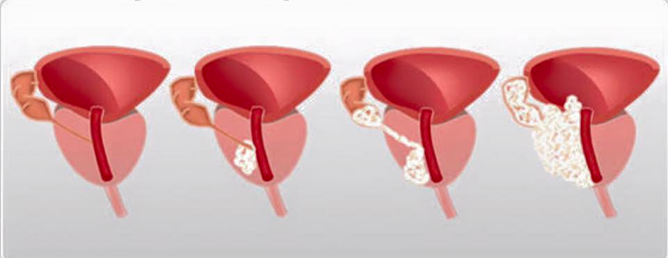 Tumore alla prostata